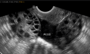 PCOS ultrason 300x182 Yumurtalık Kisti Tedavisi